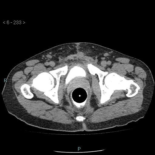 Colo-cutaneous fistula (Radiopaedia 40531-43129 A 98).jpg