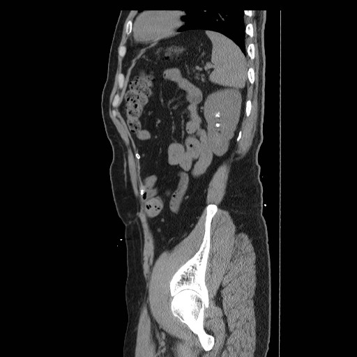 File:Colocutaneous fistula in Crohn's disease (Radiopaedia 29586-30093 C 50).jpg