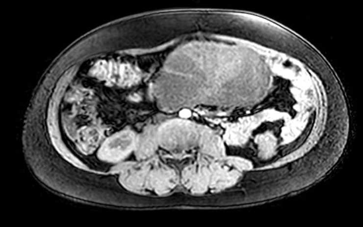 File:Colon adenocarcinoma with Krukenberg tumors, advanced pregnancy (Radiopaedia 67279-76645 A 43).jpg