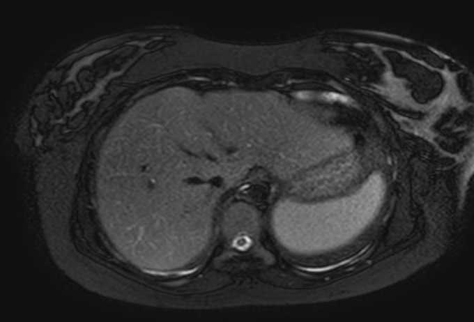 Colon adenocarcinoma with Krukenberg tumors, advanced pregnancy (Radiopaedia 67279-76645 Axial T2 SPAIR 75).jpg