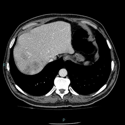 Colon adenocarcinoma with calcific liver metastasis (Radiopaedia 55745-62300 B 4).jpg