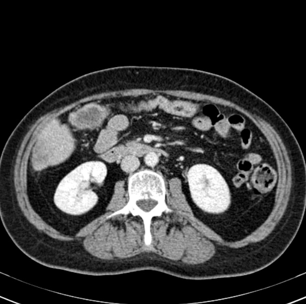 Colon carcinoma with hepatic metastases (Radiopaedia 29477-29961 A 53).jpg