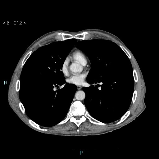 File:Colonic cancer (ultrasound and TC imaging) (Radiopaedia 50346-55713 B 212).jpg