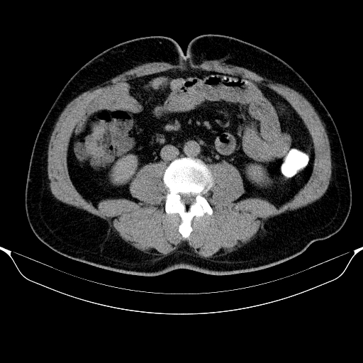 Colonic lipoma with colo-colic intussusception (Radiopaedia 58944-66200 Axial C+ rectal 35).jpg