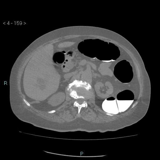 File:Colonic lipomas (Radiopaedia 49137-54244 Axial bone window 71).jpg