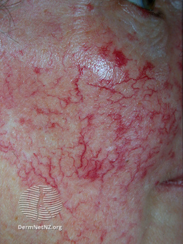 File:Familial telangiectasia (DermNet NZ vascular-telangiectases-04).jpg
