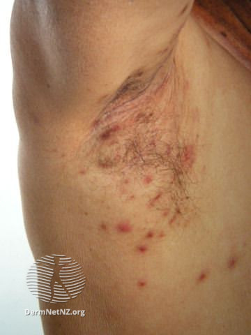 File:Folliculitis in axilla (DermNet NZ acne-folliculitis4).jpg