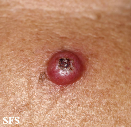 File:Keratoacanthoma (Dermatology Atlas 42).jpg