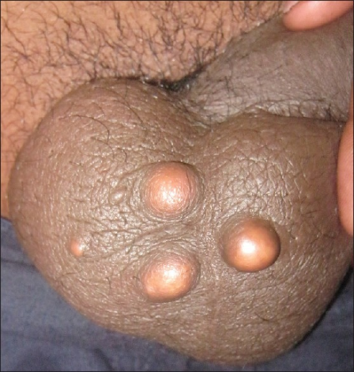File:Multiple sebaceous cysts scrotum.png
