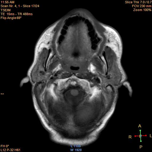 File:Nasopharyngeal carcinoma (Radiopaedia 22375-22403 Axial T1 8).jpg