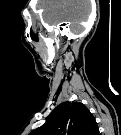 File:Nasopharyngeal carcinoma - infiltrating the clivus (Radiopaedia 62583-70875 C 11).jpg