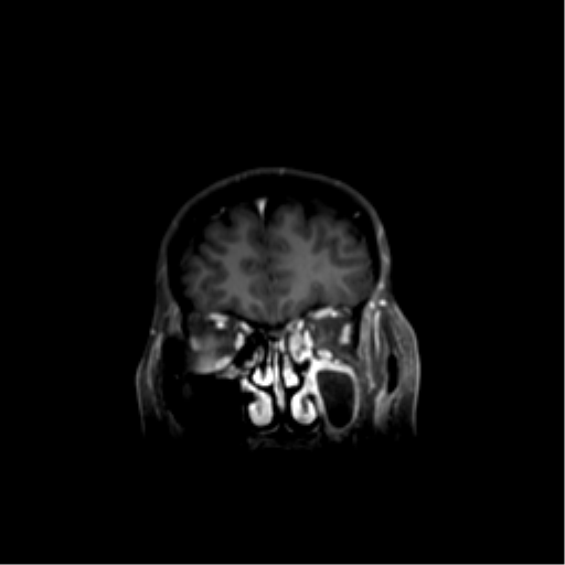 File:Nasopharyngeal carcinoma with cerebral abscess (Radiopaedia 43018-46274 L 13).png