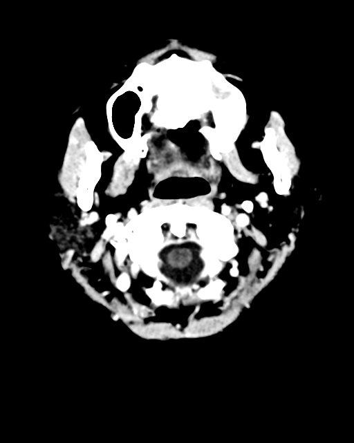 Nasopharyngeal carcinoma with cerebral abscess (Radiopaedia 43018-46275 Axial C+ delayed 4).png