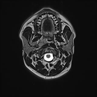 Nasopharyngeal carcinoma with perineural spread (Radiopaedia 55030-61380 Axial T2 33).jpg