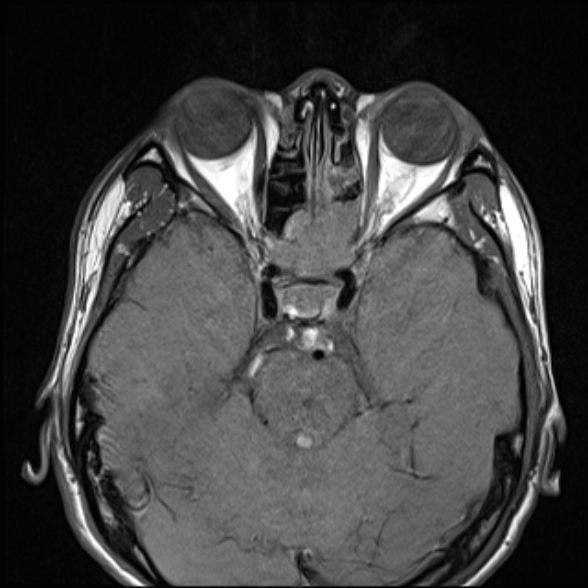 Nasopharyngeal carcinoma with skull base invasion (Radiopaedia 53415-59485 Axial T1 17).jpg