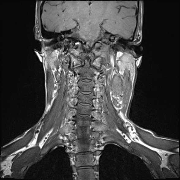 Nasopharyngeal carcinoma with skull base invasion (Radiopaedia 53415-59485 Coronal T1 12).jpg