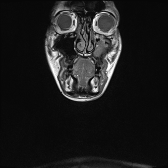 Nasopharyngeal carcinoma with skull base invasion (Radiopaedia 53415-59485 Coronal T1 37).jpg