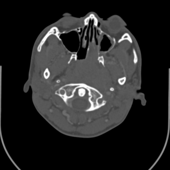 Nasopharyngeal carcinoma with skull base invasion (Radiopaedia 53415-59705 Axial bone window 43).jpg