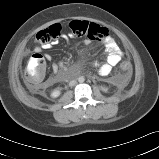 Necrotizing pancreatitis (Radiopaedia 50998-56540 A 43).png