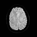 File:Neuro-Behcet's disease (Radiopaedia 21557-21506 Axial DWI 19).jpg