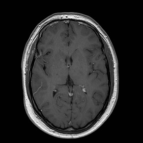 File:Neuro-Behcet's disease (Radiopaedia 21557-21506 Axial T1 C+ 15).jpg