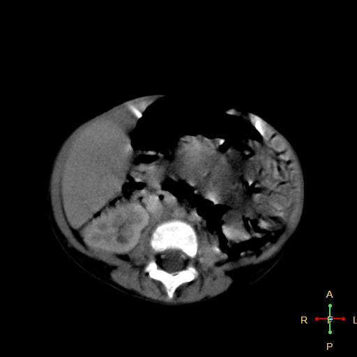 File:Neuroblastoma (Radiopaedia 24751-25016 D 24).jpg