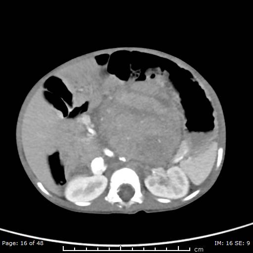 File:Neuroblastoma (Radiopaedia 41472-44355 A 16).jpg