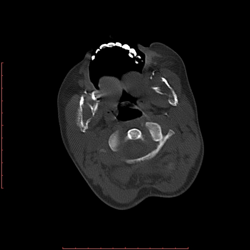 File:Neuroblastoma skull metastasis (Radiopaedia 56053-62683 Axial bone window 2).jpg