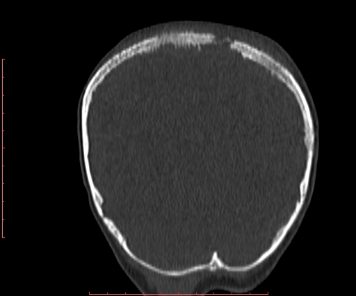 File:Neuroblastoma skull metastasis (Radiopaedia 56053-62683 Coronal bone window 35).jpg