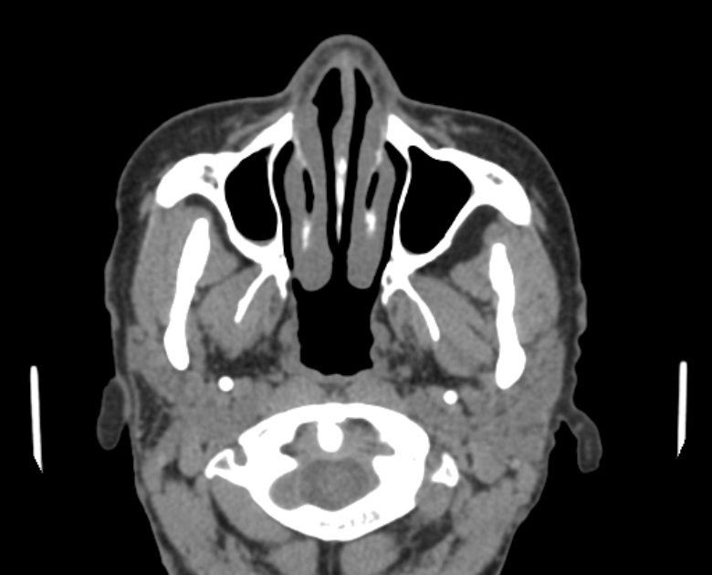 Neurofibromatosis type 1- orbital manifestations (Radiopaedia 49391-54511 Axial non-contrast 21).jpg