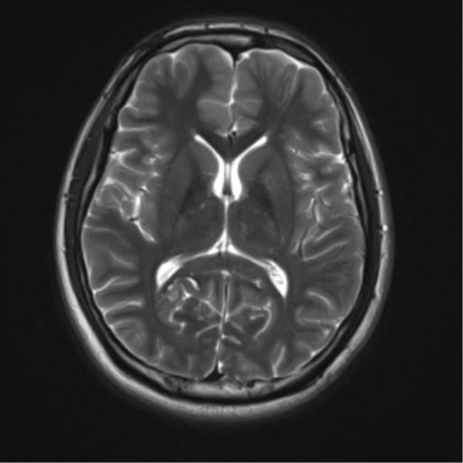 File:Neurofibromatosis type 2 (Radiopaedia 44936-48838 Axial T2 13).png