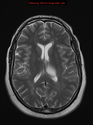 File:Neuroglial cyst (Radiopaedia 10713-11184 Axial T2 10).jpg