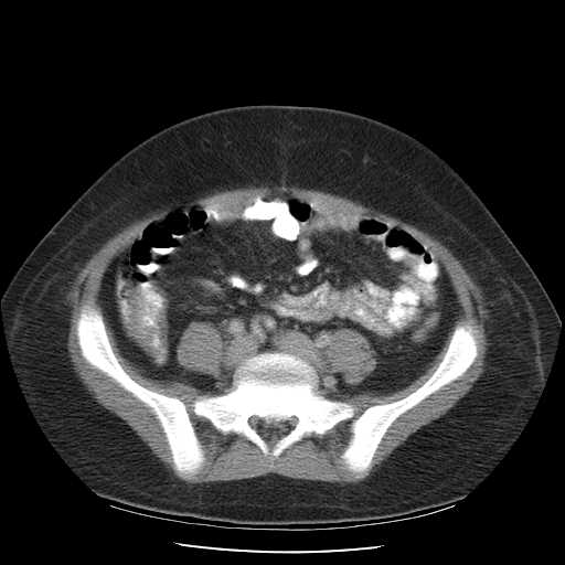 File:Non-Hodgkin lymphoma involving pelvis (Radiopaedia 21281-21197 A 44).jpg