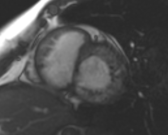 File:Non-compaction of the left ventricle (Radiopaedia 69436-79314 Short axis cine 150).jpg