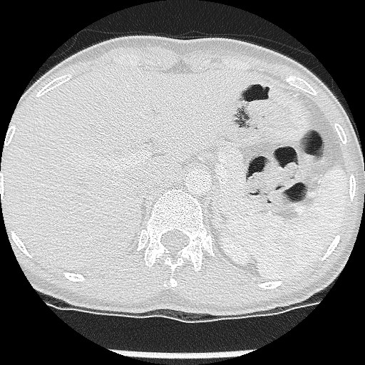 File:Non-small cell lung cancer with miliary metastases (Radiopaedia 23995-24193 Axial lung window 24).jpg