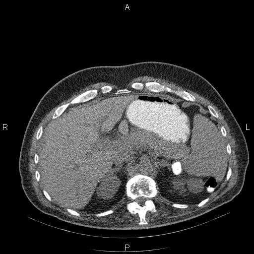 File:Non Hodgkin lymphoma in a patient with ankylosing spondylitis (Radiopaedia 84323-99624 Axial non-contrast 33).jpg