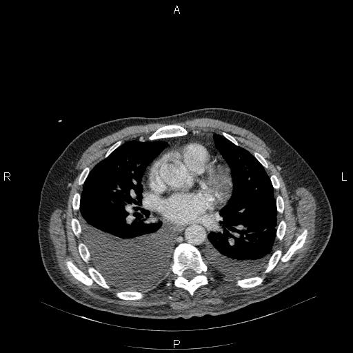 File:Non Hodgkin lymphoma in a patient with ankylosing spondylitis (Radiopaedia 84323-99624 B 16).jpg