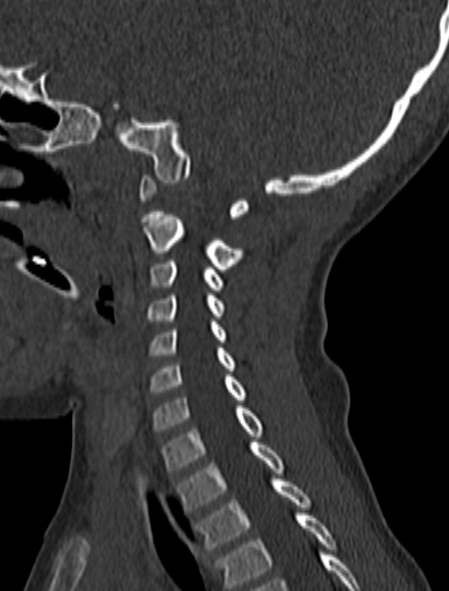 Normal CT cervical spine - pediatric (Radiopaedia 52549-58462 Sagittal bone window 71).jpg