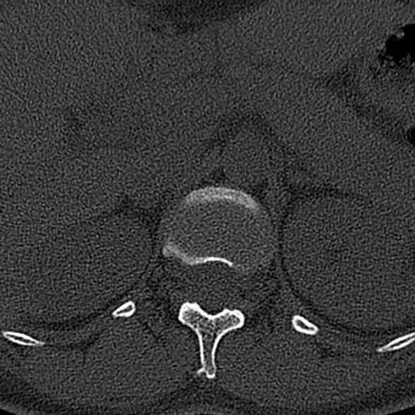 File:Normal CT lumbar spine (Radiopaedia 53981-60118 Axial bone window 6).jpg