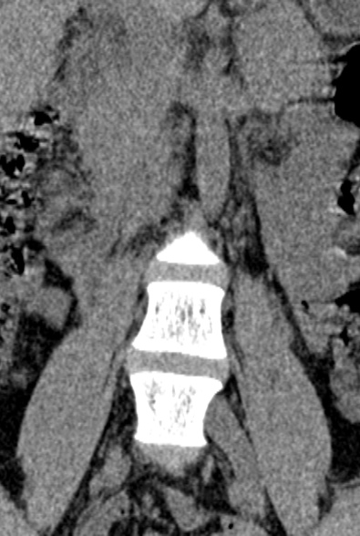 Normal CT lumbar spine (Radiopaedia 53981-60118 F 10).jpg