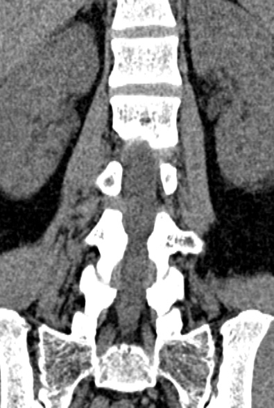 Normal CT lumbar spine (Radiopaedia 53981-60118 F 50).jpg