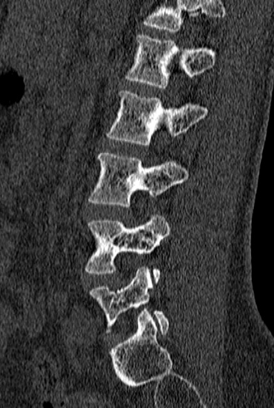 File:Normal CT lumbar spine (Radiopaedia 53981-60118 Sagittal bone window 66).jpg