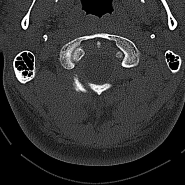 Normal CT of the cervical spine (Radiopaedia 53322-59305 Axial bone window 49).jpg