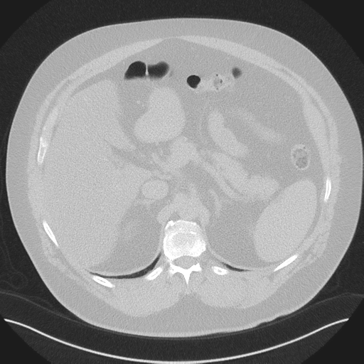 Normal HRCT (Radiopaedia 40797-43458 Axial lung window 61).png