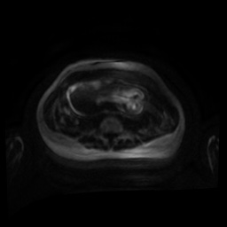 Normal MRI abdomen in pregnancy (Radiopaedia 88001-104541 Axial DWI 104).jpg
