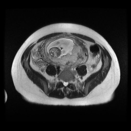 Normal MRI abdomen in pregnancy (Radiopaedia 88003-104546 Axial T2 29).jpg