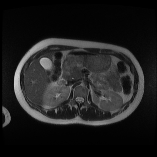 Normal MRI abdomen in pregnancy (Radiopaedia 88003-104546 Axial T2 8).jpg