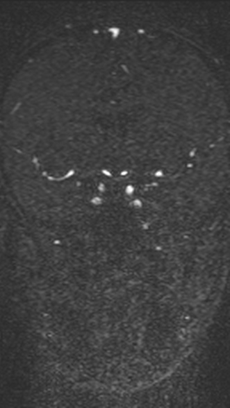 Normal MRI brain with MRV- teenager (Radiopaedia 49425-54553 Coronal MRV 111).jpg