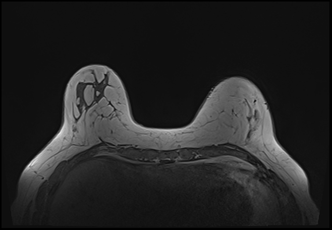 File:Normal breast MRI - dense breasts (Radiopaedia 80454-93850 Axial T1 54).jpg