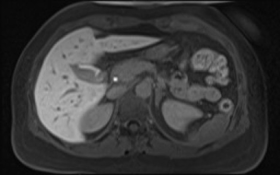 File:Normal hepatobiliary phase liver MRI (Radiopaedia 58968-66230 A 45).jpg